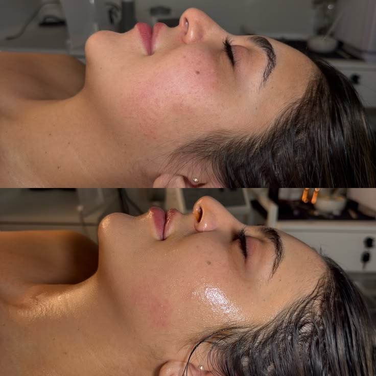 Resultado de Dermaplaning