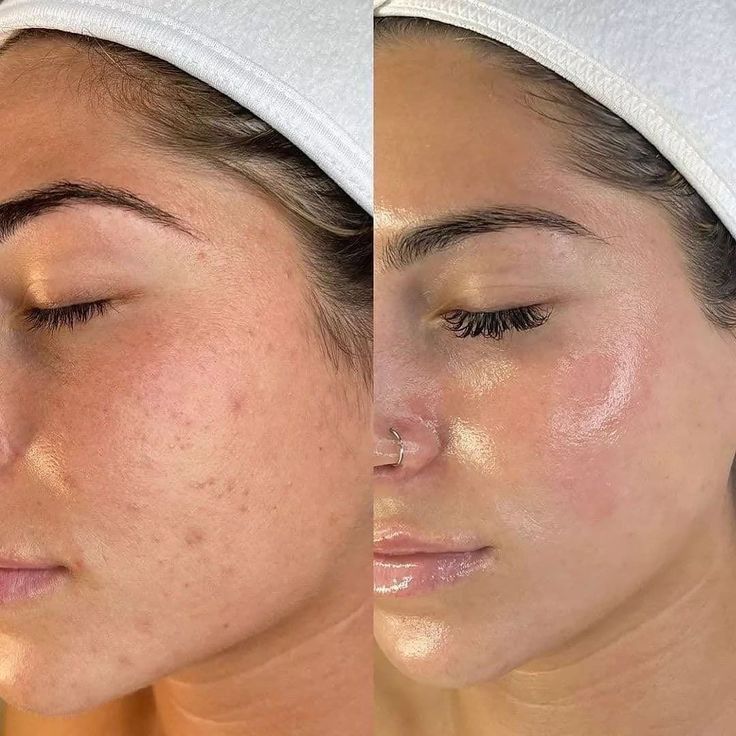 Resultado de Limpeza de pele